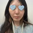 糸リフト BON BON CLINIC 銀座駅前本院 BEFORE サムネイル用