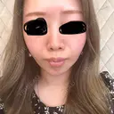 ヒアルロン酸注入（鼻） / ヒアルロン酸注入（あご） / ボトックス（眉間） 共立美容外科 福岡院 BEFORE サムネイル用