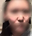 脂肪溶解注射（顔） / ヒアルロン酸注入（鼻翼基部） SK新宿歌舞伎町美容外科・歯科 BEFORE サムネイル用