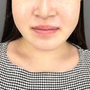 ヒアルロン酸注入（鼻翼基部） ziz CLINIC BEFORE サムネイル用