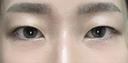 二重埋没 / クマ治療 / 上まぶたの脂肪取り / 下まぶたの脂肪取り NARU Beauty Clinic 【ナルクリ】 BEFORE サムネイル用