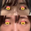ヒアルロン酸注入（涙袋） / ヒアルロン酸注入（唇） / ボトックス（人中） HAAB×DREAM BEAUTY CLINIC 東京本院 BEFORE サムネイル用