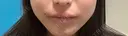 その他（口元） アネシス美容クリニック BEFORE サムネイル用