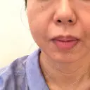 糸リフト BAO CLINIC 梅田院 BEFORE サムネイル用