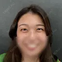二重埋没 ネビュラクリニック 京都院 BEFORE サムネイル用