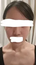 水光注射（ハリ・美肌） RAISE CLINIC 【レイズクリニック】 BEFORE サムネイル用