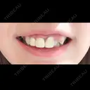 その他（審美歯科/矯正歯科） / セラミック 東京美容外科 赤坂院 BEFORE サムネイル用