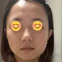 ヒアルロン酸注入（唇） / ルメッカ ルラ美容クリニック 大宮院 / ルラスキンクリニック 大宮院 BEFORE サムネイル用