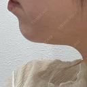 ハイフ（顔） / エレクトロポレーション ちぐさ内科クリニック 覚王山 BEFORE サムネイル用