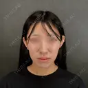 二重埋没 / 目頭切開 / 糸リフト / 脂肪吸引（顔） / ヒアルロン酸注入（涙袋） / ヒアルロン酸注入（あご） / ボトックス（エラ・小顔） / ボトックス（人中） ネビュラクリニック 京都院 BEFORE サムネイル用