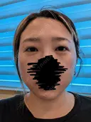 上まぶたたるみ取り / ダーマペン / 毛穴洗浄（ハイドラフェイシャルなど） Leap beauty clinic BEFORE サムネイル用