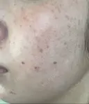 その他（肌） / 光治療（フォトフェイシャルなど） ゆきスキンクリニック 東池袋 BEFORE サムネイル用