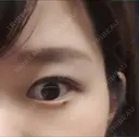 二重埋没 共立美容外科 渋谷院 BEFORE サムネイル用