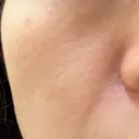 フラクショナルレーザー（毛穴・ニキビ跡） ガーデンクリニック 名古屋院 BEFORE サムネイル用