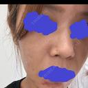 ポテンツァ NARU Beauty Clinic 【ナルクリ】 BEFORE サムネイル用