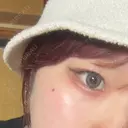 ほくろ・いぼ除去レーザー（肌） 大塚美容形成外科 京都院 BEFORE サムネイル用
