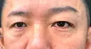 下まぶたたるみ取り / 下まぶたの脂肪取り / 脂肪注入（目の下） 湘南美容クリニック 千葉センシティ院 BEFORE サムネイル用