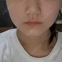 糸リフト / 脂肪吸引（顔） / ボトックス（エラ・小顔） ルラ美容クリニック 広島院 BEFORE サムネイル用