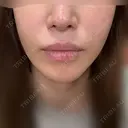 糸リフト / バッカルファット除去 / 脂肪吸引（顔） / ジョールファット除去 BLINC CLINIC （ブリンク クリニック） BEFORE サムネイル用