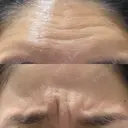 ボトックス（眉間） / ボトックス（額） / その他（鼻） ROOTS Clinic BEFORE サムネイル用