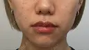 ボトックス（エラ・小顔） / ボトックス（肩） ちぐさ内科クリニック 覚王山 BEFORE サムネイル用