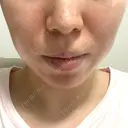 糸リフト / 脂肪吸引（顔） EMMA CLINIC（エマクリニック） BEFORE サムネイル用