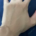 脂肪注入（肌） EMMO FACE CLINIC 大阪梅田院 BEFORE サムネイル用