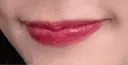 ヒアルロン酸注入（唇） REAL BEAUTY CLINIC 新宿東口院 BEFORE サムネイル用