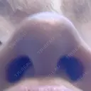 隆鼻術 / ヒアルロン酸注入（鼻） 渋谷美容外科クリニック 新宿院 BEFORE サムネイル用