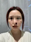 糸リフト / ボトックス（あご） / ヒアルロン酸注入（あご） Tokyo Tensei Clinic 銀座院 BEFORE サムネイル用