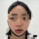 骨切り（あご） / 脂肪吸引（顔） アーククリニック BEFORE サムネイル用