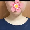 糸リフト / 脂肪吸引（顔） EMMA CLINIC（エマクリニック） BEFORE サムネイル用