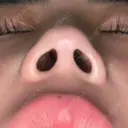 鼻中隔延長（非切開） 渋谷美容外科クリニック 渋谷院 BEFORE サムネイル用