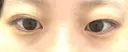 二重埋没 シンデレラ＆ダヴィンチクリニック BEFORE サムネイル用