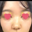 骨切幅寄せ 9BeautyClinic BEFORE サムネイル用