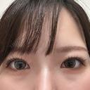 ヒアルロン酸注入（涙袋） NARU Beauty Clinic 【ナルクリ】 BEFORE サムネイル用