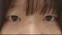 二重埋没 ルラ美容クリニック 渋谷本院 BEFORE サムネイル用