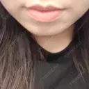 ヒアルロン酸注入（涙袋） / ヒアルロン酸注入（唇） 共立美容外科 梅田院 BEFORE サムネイル用