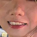 ボトックス（エラ・小顔） / エレクトロポレーション / ミラノリピール CLINIC W BEFORE サムネイル用