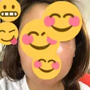 脂肪溶解注射（顔） 聖心美容クリニック 広島院 BEFORE サムネイル用