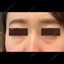 クマ治療 / 下まぶたたるみ取り / 下まぶたの脂肪取り APOLLO BEAUTY CLINIC BEFORE サムネイル用