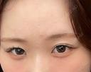 二重埋没 / その他（目元） / クマ治療 / ボトックス（エラ・小顔） / ヒアルロン酸注入（額） / ボトックス（肩） TCB東京中央美容外科 京都四条院 BEFORE サムネイル用