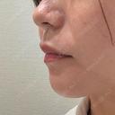 ボトックス（エラ・小顔） / ボトックス（肩） / ヒアルロン酸注入（鼻翼基部） おおたかの森ビューティークリニック BEFORE サムネイル用