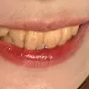 ホワイトニング LEAGRANT CLINIC 中目黒 BEFORE サムネイル用