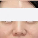 クマ治療 / ヒアルロン酸注入（目の下） ROOTS Clinic BEFORE サムネイル用