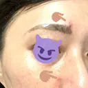 ポテンツァ 渋谷美容外科クリニック 横浜院 BEFORE サムネイル用