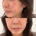 シミ取りレーザー G MEDICAL ART クリニック 新宿院 BEFORE サムネイル用