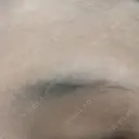 医療脱毛（顔） LIFIX BEAUTY CLINIC BEFORE サムネイル用