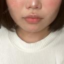 ヒアルロン酸注入（あご） / ボトックス（エラ・小顔） / 脂肪溶解注射（顔） 東京美容外科 池袋院 BEFORE サムネイル用