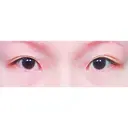 二重切開 / 目頭切開 / 上まぶたの脂肪取り / 蒙古ひだ形成 FROM B整形外科 (旧バウム整形外科) BEFORE サムネイル用